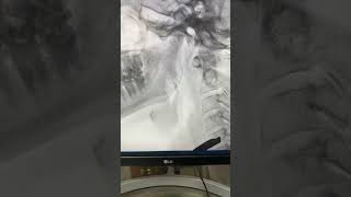 Lateral video fluoroscopy  how does it look [upl. by Nitas]