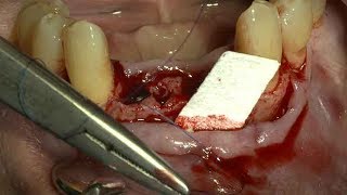 Suturing technique for the fixation of the Collagen MembraneDrCho SeungHwan [upl. by Hpejsoj615]