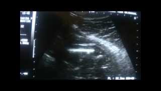 ultrasound  determining fetal femur length [upl. by Nylrebma7]