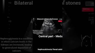 Renal calcinosis [upl. by Ardnekal]