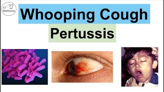 Whooping Cough Pertussis  Transmission Pathophysiology Symptoms Diagnosis Treatment [upl. by Eeladnerb682]