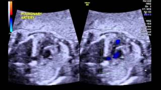 Tetralogy of Fallot with pulmonary stenosis 3 vessel view [upl. by Karin]