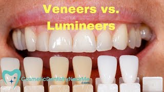 Veneers vs Lumineers [upl. by Portingale]