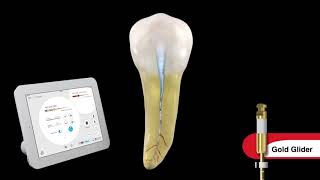 Endodontic Canal Preparation with Dr Ruddle [upl. by Thurmann]