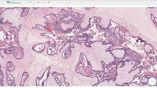 Complete Hydatidiform Mole  Histopathology [upl. by Odlaniger53]