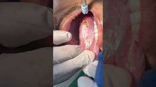 LEUKOPLAKIA REMOVAL [upl. by Lesh]