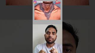 pellagra disease vitaminb3 pellagra disease ytshots raheesansari doctor mbbs aiims ❤️💥💯 [upl. by Meekar]