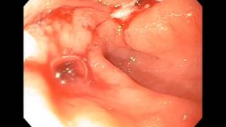 Gastric Outlet Obestruction from Pyloric Ulcers [upl. by Ihel50]