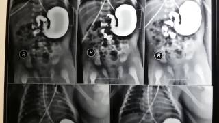 Barium meal showing malrotation of intestine Note intestinal content on one side [upl. by Yeltneb]