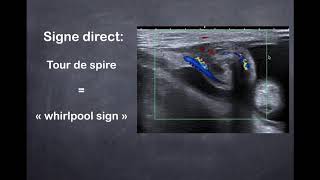 Pathologies génitauxscrotales  1 Torsion testiculaire [upl. by Sukramaj]