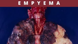 Empyema Causes Symptoms Treatment and Prevention [upl. by Imeka]