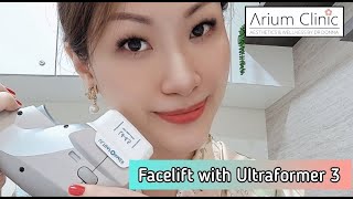 Facelift with Ultraformer 3 HIFU at Arium Clinic [upl. by Kiryt]