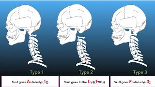 Atlanto occipital dislocation lecture [upl. by Kristofor]