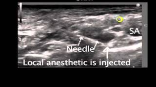 Ultrasound Guided Supraclavicular Nerve Block [upl. by Idona]