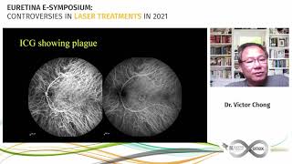 EURETINA 2021  CONTROVERSIES IN LASER TREATMENTS IN 2021 [upl. by Daisi317]