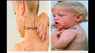 Penyakit Rubella  Campak Jerman [upl. by Artep]