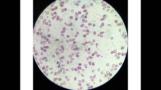 microcytic hypochromic anaemia [upl. by Nrubloc720]