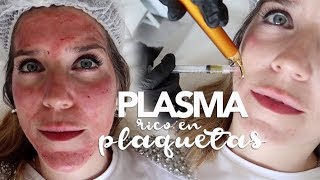 ME INYECTAN PLASMA RICO EN PLAQUETAS  MARTA IBRAHIM [upl. by Aliemaj]