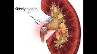 Nephrolithiasis [upl. by Atalee]