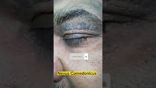 Comedo Nevus😱🔥  Nevus Comedonicus on upper eyelid in old patient dermatology comedone acne scar [upl. by Adnahsed]