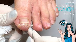 Callus amp hyperkeratosis removalΑφαίρεση κάλωνΚέντρο Ποδιού PodiatryPodiatristΠοδίατρος [upl. by Bellina]