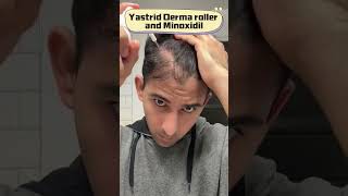 How to use derma roller for hair growth treatment [upl. by Nosittam]