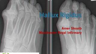 Hallux Rigidus [upl. by Steinman174]