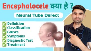 Encephalocele in Hindi  Causes Symptoms And Treatment of Encephalocele [upl. by Onil]