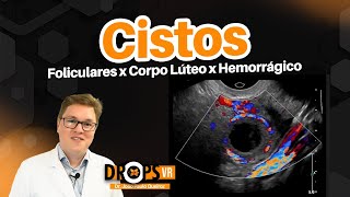 CISTOS OVARIANOS FUNCIONAIS FOLICULARES DE CORPO LÚTEO E HEMORRÁGICOS NO ULTRASSOM [upl. by Artemas]