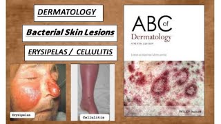 DERMATOLOGY Bacterial skin lesions  Erysipelas cellulitis derma erysiples cellulitis [upl. by Duquette]