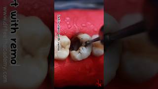 How is Root Canal Treatment RCT done dentist rct [upl. by Nanreh]