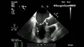 MITRAL REGURGITATION TRANSESOPHAGEAL ECHOCARDIOGRAPHY TEE  CASE 4 [upl. by Aguste]