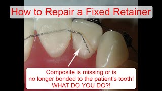 How to Repair a Fixed Retainer [upl. by Nyleuqaj]