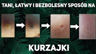 Domowy sposób na kurzajkę łatwy tani i bezbolesny [upl. by Darton]