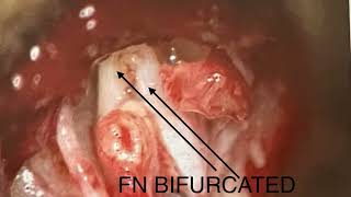 FACIAL NERVE abnormalities 2 [upl. by Free]