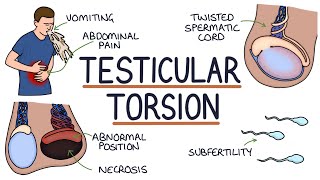 Understanding Testicular Torsion [upl. by Zebadiah]