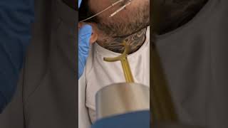 Removing Face Tattoo Live Video from the Treatment [upl. by Nnaoj]