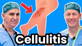 Cellulitis Explained By Infectious Disease Doc Red Sore And Swollen [upl. by Fran]