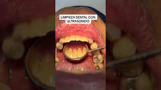 Limpieza oral con ultrasonido 🤗 [upl. by Laemaj]