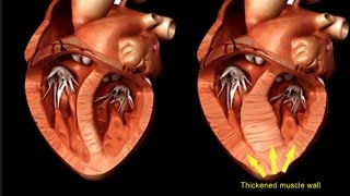 Hypertrophic Cardiomyopathy [upl. by Ahtiekal]