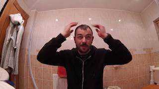 My Hair Transplant Part 1 Introduction [upl. by Leacim]