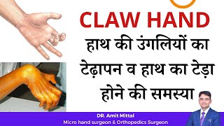 हाथ की उंगलियों का टेढ़ापन व हाथ का टेड़ा होने की समस्या  CLAW HAND EXPLAINED in Hindi [upl. by Babcock]