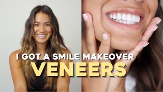 WHAT IT’S REALLY LIKE TO GET VENEERS  pain cost regrets [upl. by Nickles259]