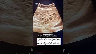 Molar pregnency in ultrasoundusg of pelvis Molar pregnancy ultrasound [upl. by Ecnerolf]