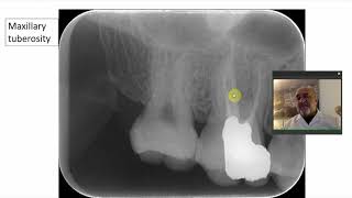 Area of upper molars Coronoid process [upl. by Fredelia]