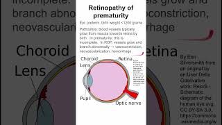 Retinopathy of prematurity [upl. by Ecenaj]