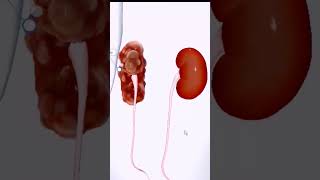 Human Anatomy Kidney  Polycystic Kidney Disease Dialysis  MBBS youtubeshorts youtube ytshorts [upl. by Harima]