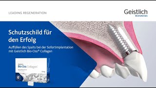 Schutzschild für den Erfolg  Geistlich BioOss® Collagen 50mg [upl. by Ailedamla428]