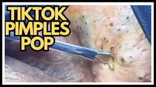 TiKToK PIMPLES POP [upl. by Emerick]