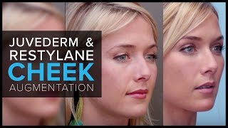 Cheek Augmentation With JUVEDERM® and Restylane® at Mabrie Facial Institute [upl. by Donaldson]